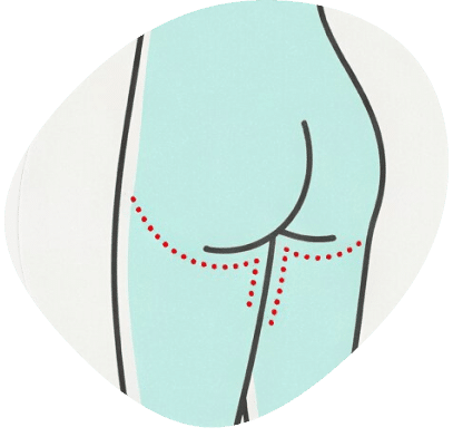 Thigh lift